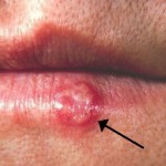 kako spriječiti herpes