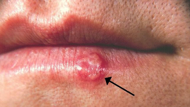 kako spriječiti herpes