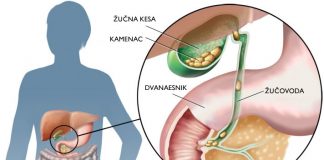 Kamen u zuci simptomi kamen u zuci simptomi
