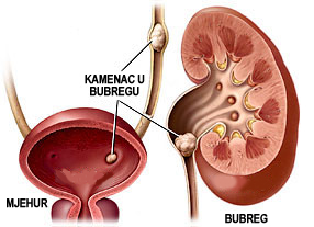 kamenac_u_bubregu