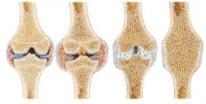 reumatoidni artritis