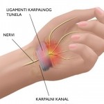 liječenje sindroma karpalnog tunela