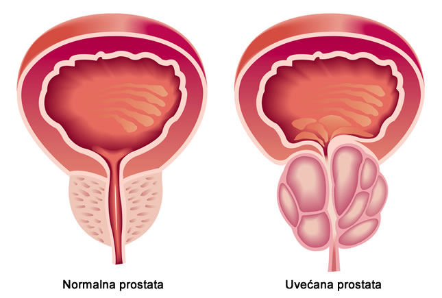 prirodni lijekovi za prostatu