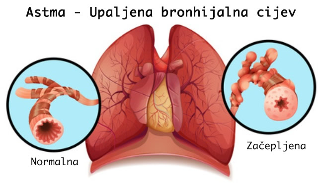 Astma - upaljena bronhijalna cijev