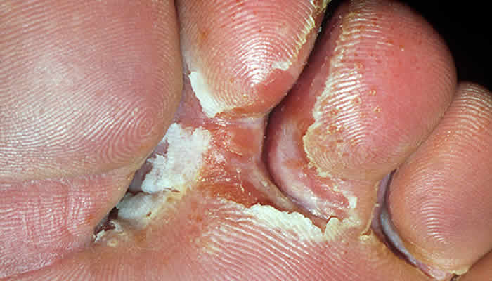 Pucanje kože između nožnih prstiju