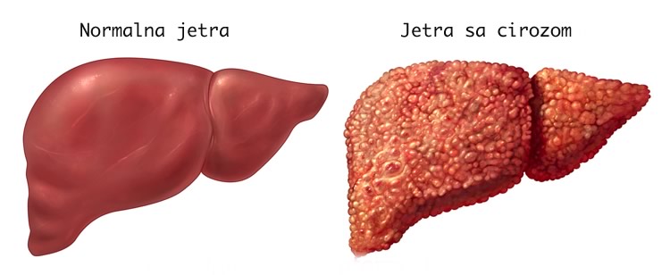Normalna jetra i jetra sa cirozom ilustracija