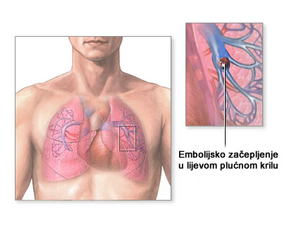 začepljenje pluća