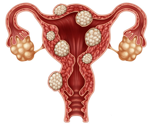 Endometrioza - upala jajnika