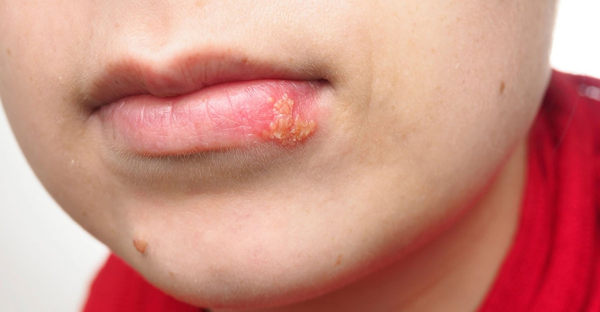 Blagajna Stvaran Vuk Ulje Cajevca I Herpes Na Usnama Kevinmolter Com