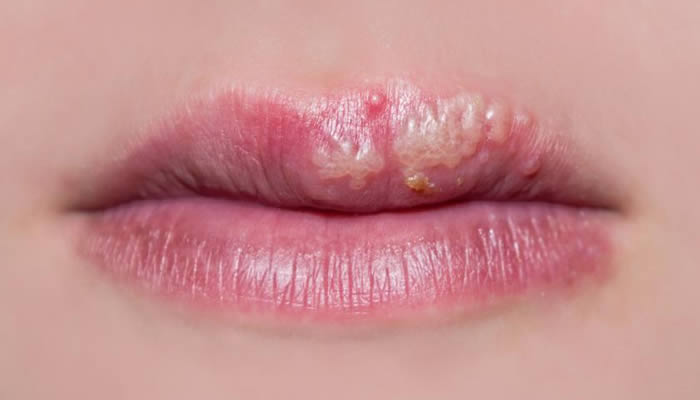 Hespes Simpleks Virus - Herpes na usni