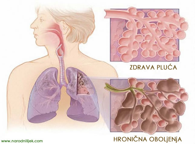 hronična-oboljenja-pluća