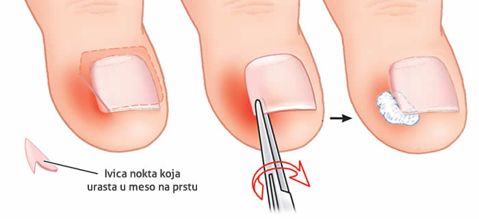 Kako izvaditi urasli nokat