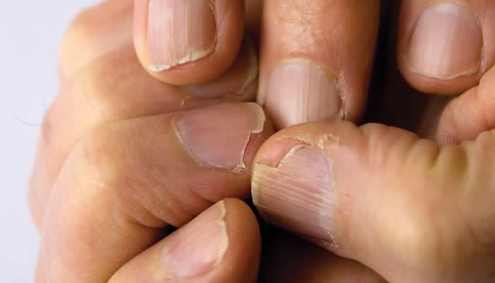 Pucanje noktiju - Lomljivi nokti