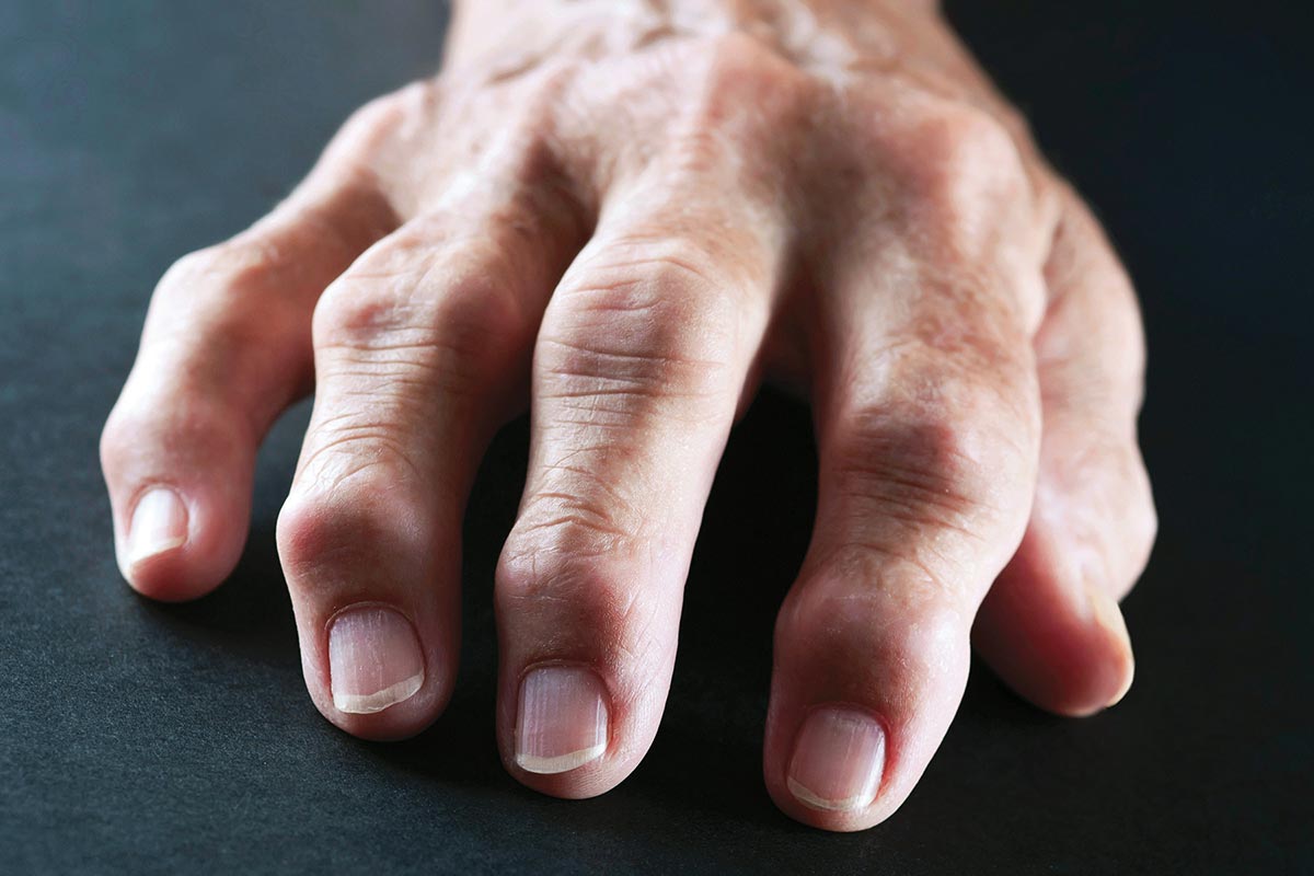 saks blato liječenje artritisa