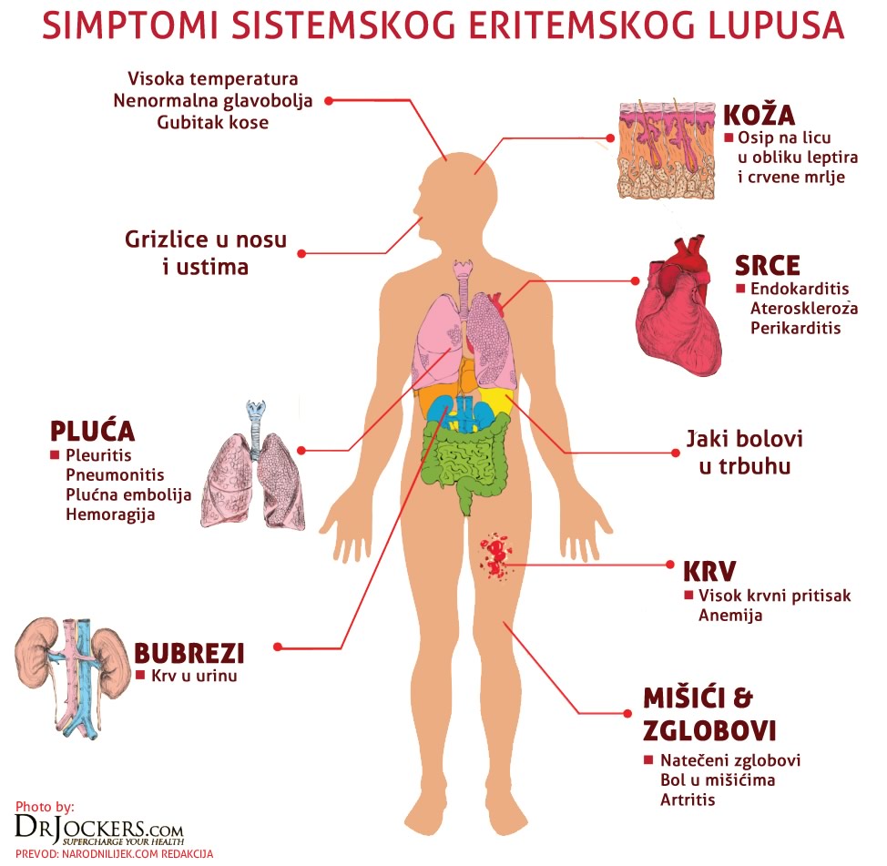 sistemski lupus liječenje hipertenzije)
