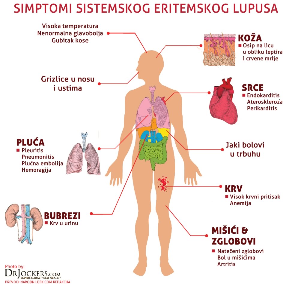 Sistemski lupus