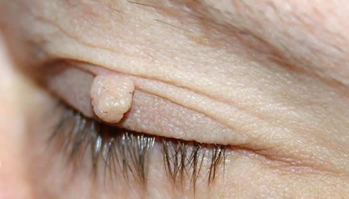 papilloma vírus és bradavice)