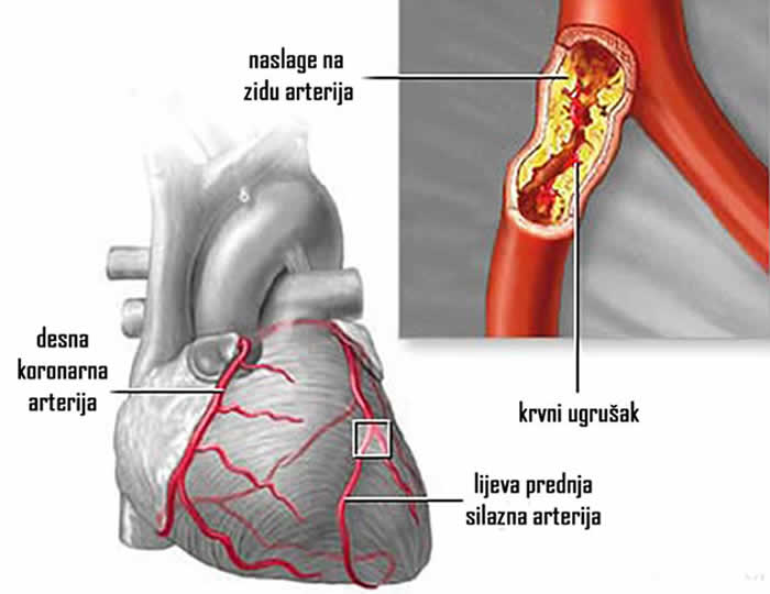 zakrčenje koronarnih arterija